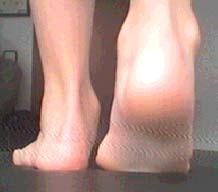 Peu Valgò tractament a Nou DMP