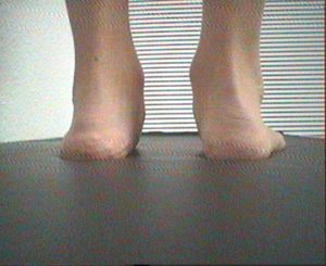 Peu valgó infantil tractamen a NOU DMP