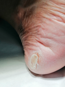 Sequetat de la pell tractament a NOU DMP