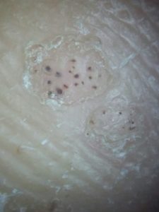 Berrugues plantars tractament a NOU DMP