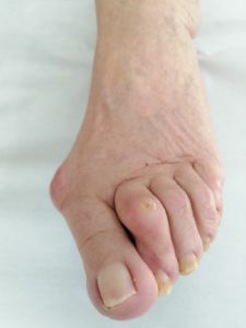 Hallux tractament a NOU DMP