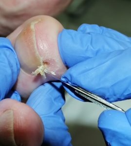 Tractament heloma a NOU DMP