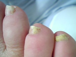 Onicomicosi patologia NOU-DMP