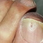 Heloma subungueal