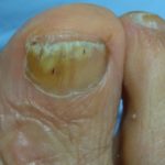 onicomicosis NOU-DMP