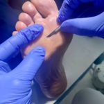 Hiperquerastosi